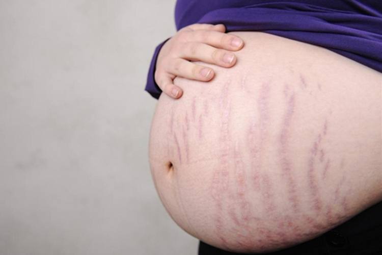 stretch marks during pregnancy